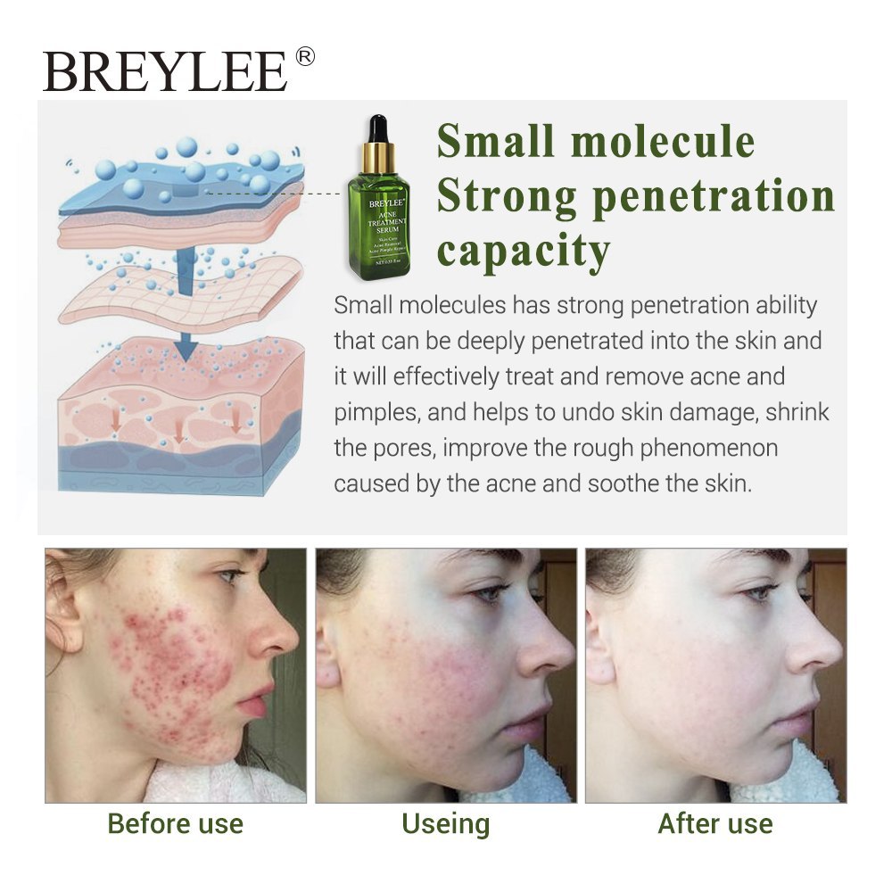 BREYLEE Acne Treatment Serum Face Facial Anti Acne Scar Removal Cream