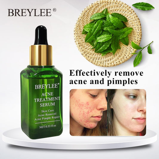 BREYLEE Acne Treatment Serum Face Facial Anti Acne Scar Removal Cream