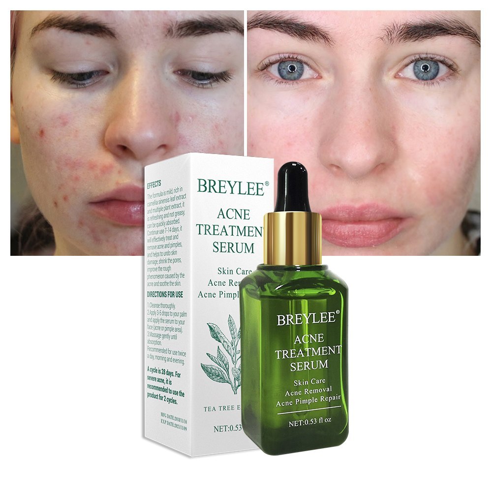 BREYLEE Acne Treatment Serum Face Facial Anti Acne Scar Removal Cream